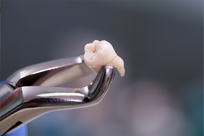 不用歯の抜歯・歯髄幹細胞の採取と培養