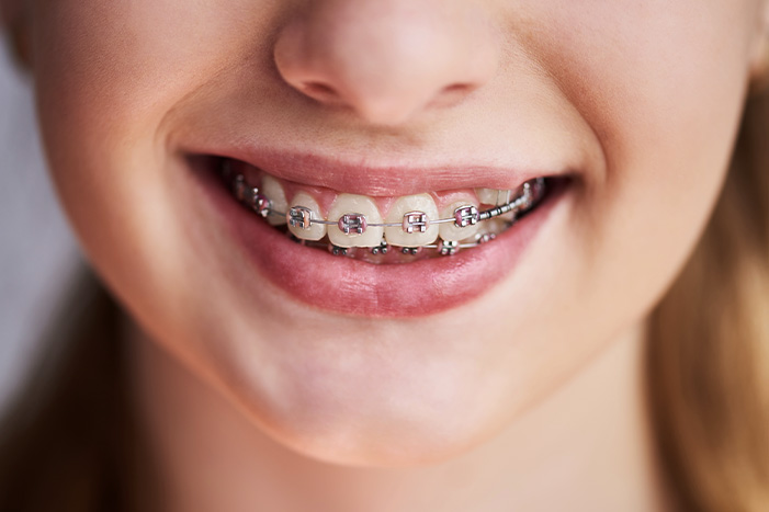 歯並びによってはワイヤー矯正の併用も検討